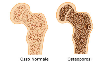 OSTEOPOROSI